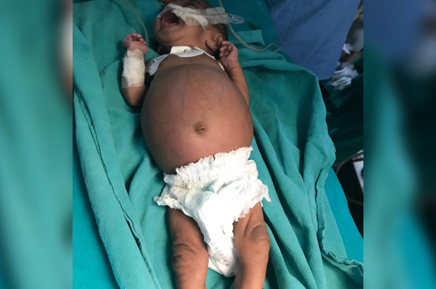 印度女婴肚子莫名肿大 医生竟在其体内发现寄生胎